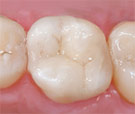 Tooth-Colored Fillings in real tooth Piscataway, NJ